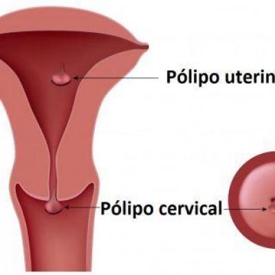 Como quitar los polipos uterinos