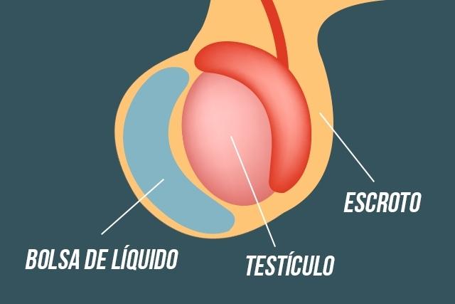 tratamiento natural hidrocele